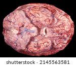 Small photo of Gross anatomy of the basal surface of a human brain with diffuse purulent exudates along the cerebellum, medulla oblongata and pons. This type of basal meningitis is frequent in tuberculous infections