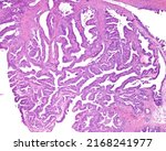 Small photo of Ovarian mucinous cystadenoma (15-20% of ovarian tumours) is a usually large and benign tumour showing glands and cysts, with filiform papillae with fibrovascular cores, lined by columnar epithelium.