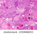 Small photo of Human meningioma. Meningioma cells are relatively uniform, with a tendency to encircle one another, forming whorls and psammoma bodies, concentric laminated eosinophilic bodies that tend to calcify.
