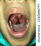 Small photo of Close up of enlarged tonsil glands in a boy with obstructive sleep apnea. (history of long duration snoring.)