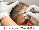 Small photo of Drawing for hair transplant for woman with sparse hair