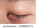 Small photo of Close up of eye handsome man painfully abscess eye stye ophthalmic, under the eyes, hoodlum infection virus or disease during close eye, Health concept