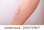 Small photo of Leg with varicose veins. Leg with disease of varicose veins on a light background.