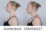 Small photo of Before and after kyphosis. The woman suffers from a curvature of the spine in the upper section. The cervical vertebrae bulge out and form a hump. Curvature and incorrect posture treatment concept