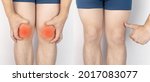 Small photo of Before and after. On the left, a man is holding onto an injured knee, and on the right, doctors have already cured a patient. Ruptured knee tendons, muscles, meniscus injury, bone fracture or fissure