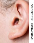 Small photo of Close up of abscess Inflammation on the ear, area of suppuration. Ear furuncle. Purulent carbuncle. Treatment of abscess