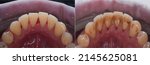 Small photo of teeth calculus and tartar cleaning