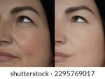 Small photo of Woman face wrinkle before and after treatment