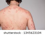 Small photo of Dermatological skin disease, psoriasis, more pronounced on the elbows,Psoriasis skin. Psoriasis is an autoimmune disease that affects the skin cause skin inflammation red and scaly