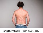 Small photo of Dermatological skin disease, psoriasis, more pronounced on the elbows,Psoriasis skin. Psoriasis is an autoimmune disease that affects the skin cause skin inflammation red and scaly