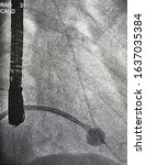 Small photo of X ray of Percutaneous transvenous mitral commissurotomy (PTMC) or percutaneous mitral balloon valvotomy (PTMV) in patient with mitral stenosis (MS)