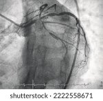 Small photo of Coronary angiography shown left main (LM) stenosis with triple vessel disease (TVD).