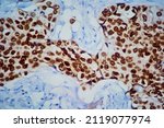 Small photo of Breast tissue adenocarcinoma immunohistochemistry. Estrogen receptors.