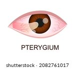Pterygium Growing Onto The...