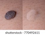 Small photo of Mole removal inborn