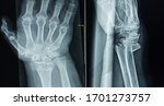 Small photo of x-ray wrist ap lateral Finding Comminuted fracture at distal meta-epiphyses of right radius,with total dorsal displacement and intra-articular extension of right wrist.Medical image concept.
