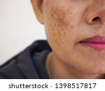 Problem skincare and health concept. Wrinkles, melasma, Dark spots, freckles, dry skin on face middle age woman . 