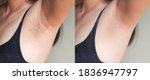 Small photo of Image before and after skincare cosmetology armpits epilation treatment concept. Problem underarm chicken skin, Fox Fordyce, black armpit in woman.