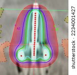 Small photo of Brachytherapy treatment planning image of cancer of cervix by placing an applicator in its position
