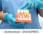 Small photo of Dental implant, artificial tooth roots into jaw, root canal of dental treatment, gum disease, teeth model for dentist studying about dentistry.