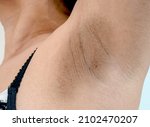 Small photo of Close up Women armpit with problem black armpit. Dark and wrinkle armpit from deodorant allergic