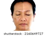 Small photo of Retouched image to show before and after treatment spot melasma pigmentation facial treatment on young asian woman face. Skincare and health problem concept.