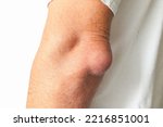 Small photo of Man swelling erythematous lump pain elbow from Olecranon bursitis, student elbow medical condition. Inflammation of the bursa located under the elbow Olecranon trauma or repetitive smaller traumas.