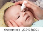 Small photo of Instillation of medicinal drops in the eye of a child to treat conjunctivitis and blockage of the tear duct. Probing of the lacrimal canal, treatment.