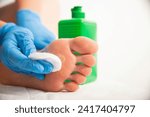 Small photo of The doctor uses a special liquid to burn a removed callus on the foot. Surgical removal of calluses and warts.