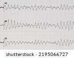 Small photo of ECG recording with torsade-like ventricular tachycardia