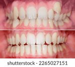Small photo of Complete smile makeover from crooked teeth to well aligned smile. Before after after using aligners invisalign or brackets