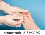Small photo of doctor disinfect injured toenail with jodine. Hands in rubber gloves touch injured toenail in clinic. Diagnosis, treatment of mycosis of feet. Podiatrist treating ingrown toenail. Inflammation of toes