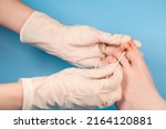 Small photo of Hands in rubber gloves touch injured toenail. doctor disinfect injured toenail with jodine in clinic. Inflammation of toes. Diagnosis, treatment of mycosis of feet. Podiatrist treating ingrown toenail