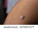 Small photo of Macro Shot of Wart on Arm