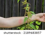 Small photo of Allergic reaction to urtica or nettle grass. Red spot and blisters on a man's hand from a stinging nettle burn. Selective focus, blurred foreground