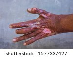 Small photo of The hand was scalded,Severely injured hand from scald or accident,Hands that are scar after surgery
