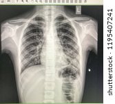 Small photo of Chest x-ray of thai girl who came to hospital with fever and cough. Flim show patchy infiltration at left lower lobe lung field.