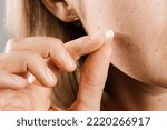 Small photo of Woman using acne patches for treatment of pimple and rosacea close-up. Facial rejuvenation cleansing cosmetology. Girl with acne stick round acne patch on her cheek