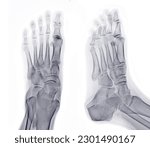 Small photo of Foot x-ray image AP and Oblique view isolated on white background.