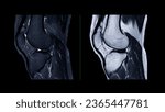 Small photo of Magnetic resonance imaging of knee joint or MRI knee sagittal for detect tear or sprain of the anterior cruciate ligament (ACL).