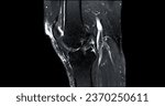 Small photo of Magnetic resonance imaging or MRI of knee joint c for detect tear or sprain of the anterior cruciate ligament (ACL)