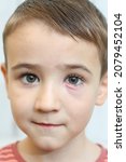 Small photo of Stye, hordeolum, bacterial infection of oil gland in eyelid. Blepharitis. Red tender bump in eyelid. Eye health. Sick kid. Child, kid with stye, hordeolum, bacterial infection by Staphylococcus aureus