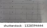 Small photo of Atrial fibrillation with complete heart block (AF with CHB). Complication from aortic valve replacement (AVR) surgery.