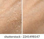 Small photo of Collage demonstrating comparison of dry and moisturized human skin, closeup