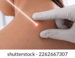 Small photo of Laser mole removal. Doctor checking patient's skin during procedure in clinic, closeup