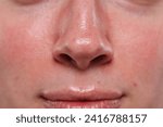 Small photo of Closeup view of woman with reddened skin