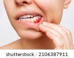 Gum inflammation. Cropped shot of a young woman showing red bleeding gums isolated on a white background. Close up. Dentistry, dental care	