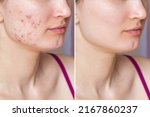 Small photo of Cropped shot of young woman's face before and after acne treatment on face. Pimples, red scars on the cheeks and chin of a girl. Problem skin, health care and beauty concept. Dermatology, cosmetology