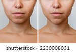 Small photo of Сhin reduction with fillers. Woman's face with jaws and chin before and after mentoplasty isolated on a gray background. The result of cosmetic plastic surgery. Beauty concept