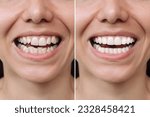 Cropped shot of a young caucasian smiling woman before and after veneers installation. Teeth whitening. Dentistry, dental treatment. Сorrection of uneven teeth with braces